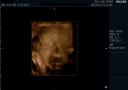 3D ultrasound of 24 week boy baby #2